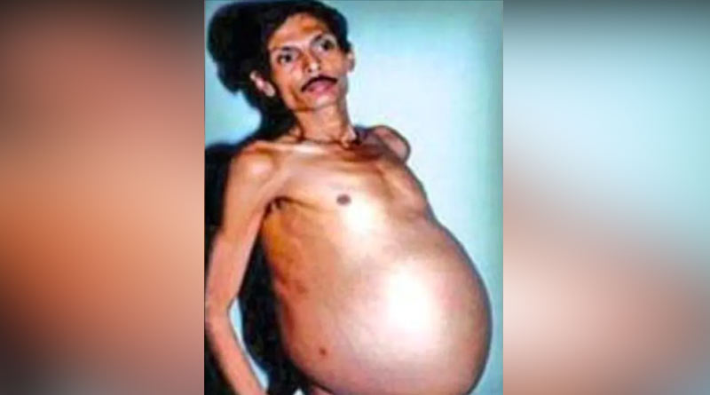In rare medical condition, a man who appeared to be pregnant in Nagpur। Sangbad Pratidin