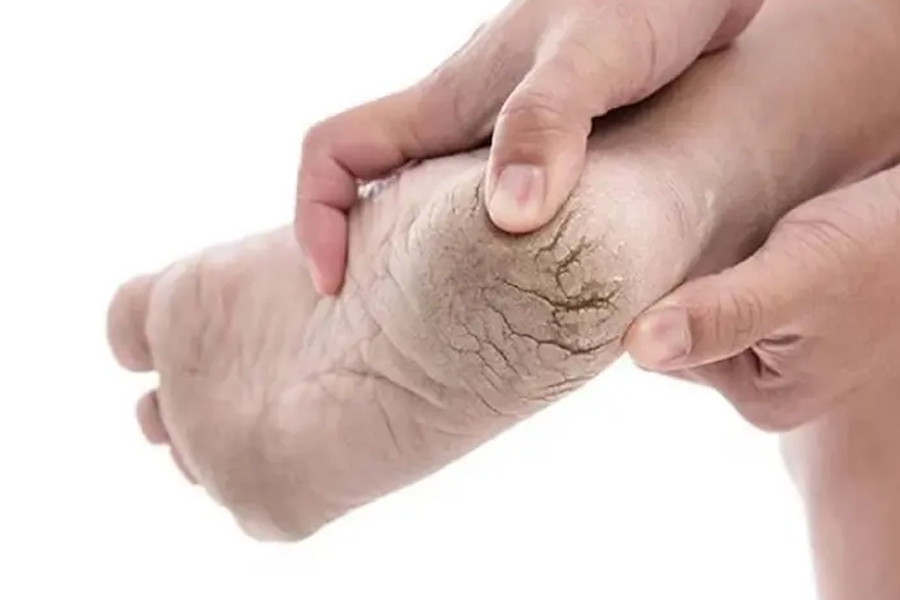 cracked-ankles-1