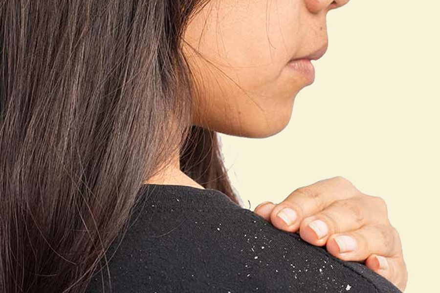 Try these Hair care Tips to reduce dandruff
