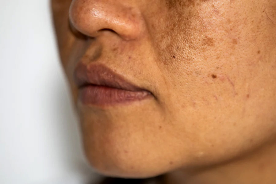 Know about Melasma and it's treatment, Expert gave this Health Tips