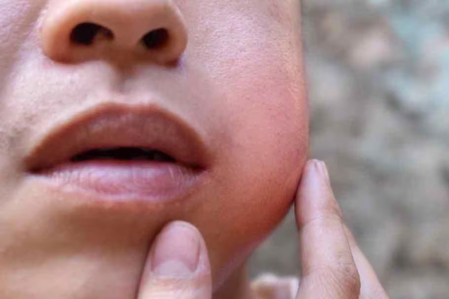 Mumps infection among children is increasing in West Bengal
