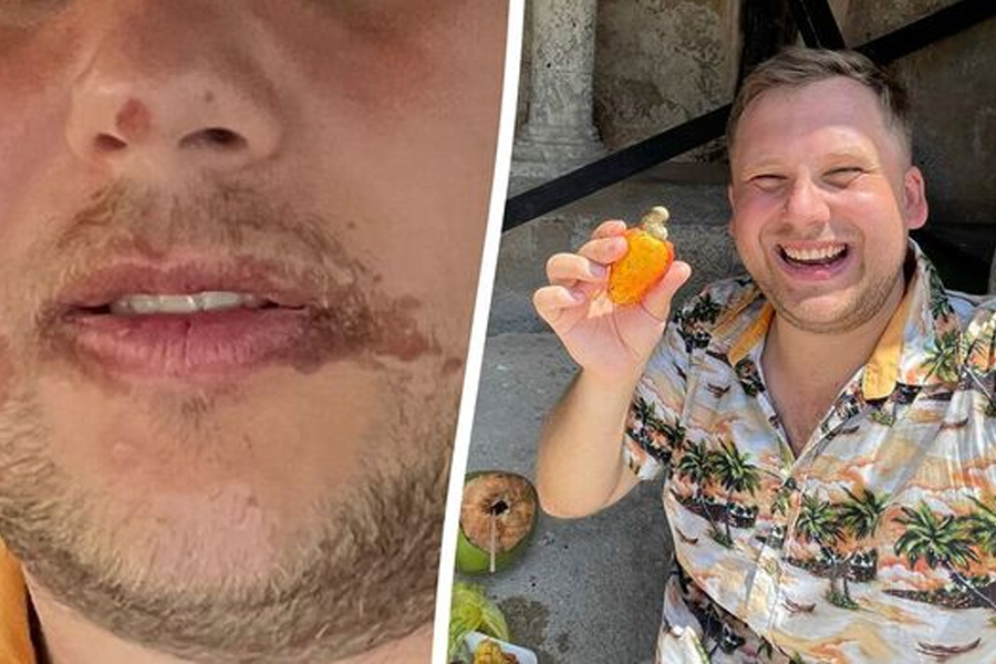 UK Man Eats Exotic Fruit In Mexico and Burnt Face