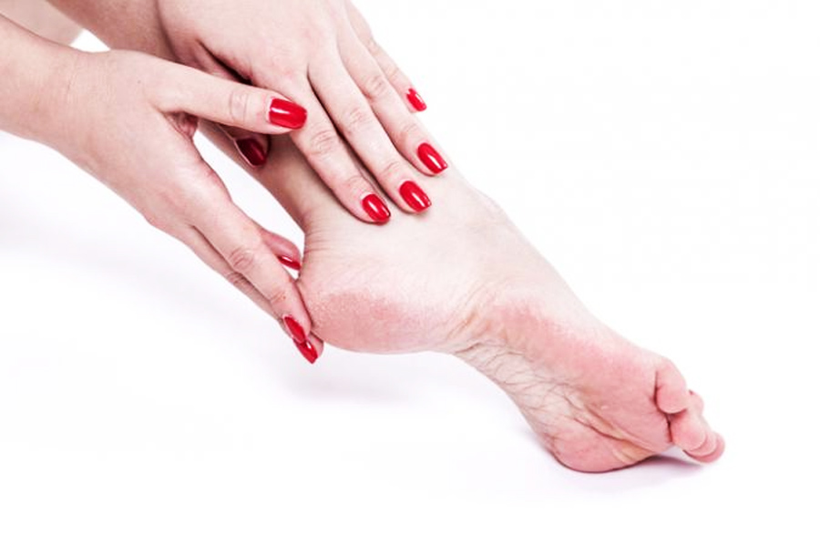 How to heel crack feet during summer season