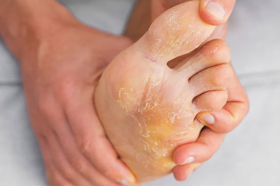 How to cure infection on feet due to waterlogging