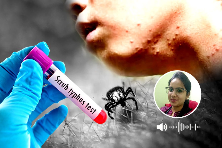 বসিরহাটে স্ক্রাব টাইফাসে আক্রান্ত শিশু! বিপদ মুক্তির উপায় জানালেন চিকিৎসক