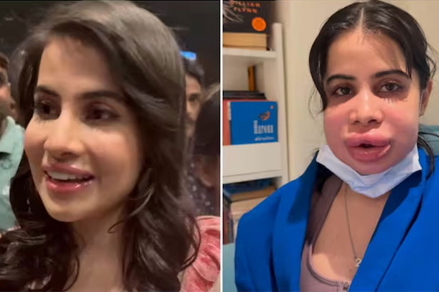 উধাও ফোলা ঠোঁট, স্বমহিমায় ফিরে কী বললেন উরফি?