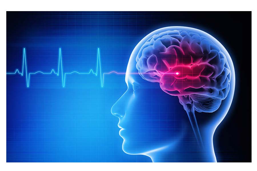 Expert Neurologist on Brain Stroke Prevention