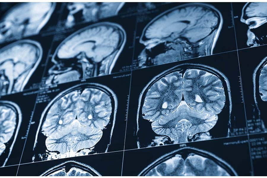 Cold showers in winter increase the risk of Brain Stroke for the elderly