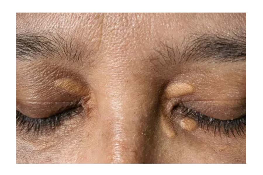 What symptoms indicate elevated cholesterol levels in the blood
