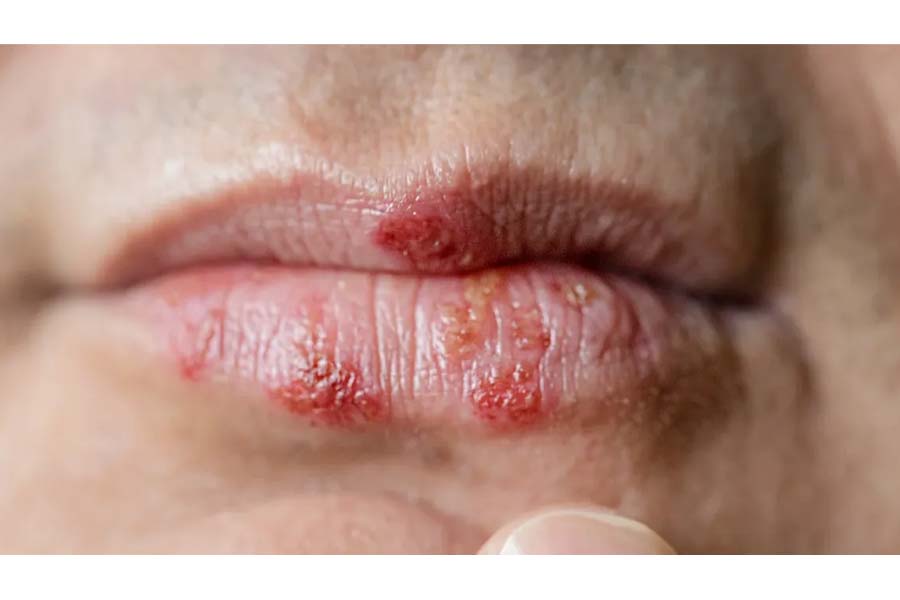 Find out how to prevent contracting Cold Sores