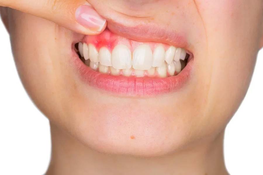Research claims that dental problems increase the risk of ischemic stroke