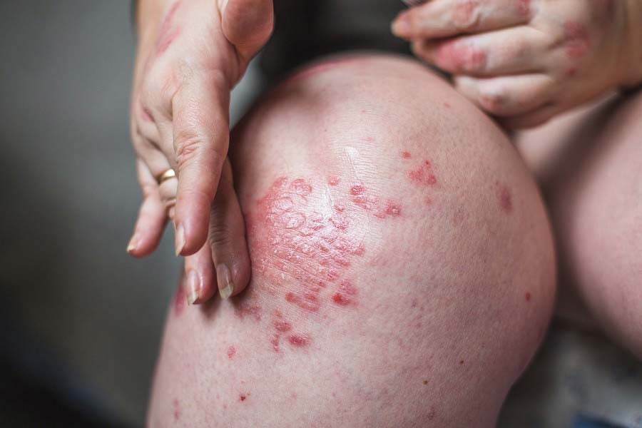 What steps should be taken early in winter to avoid Eczema - Prescription Plus