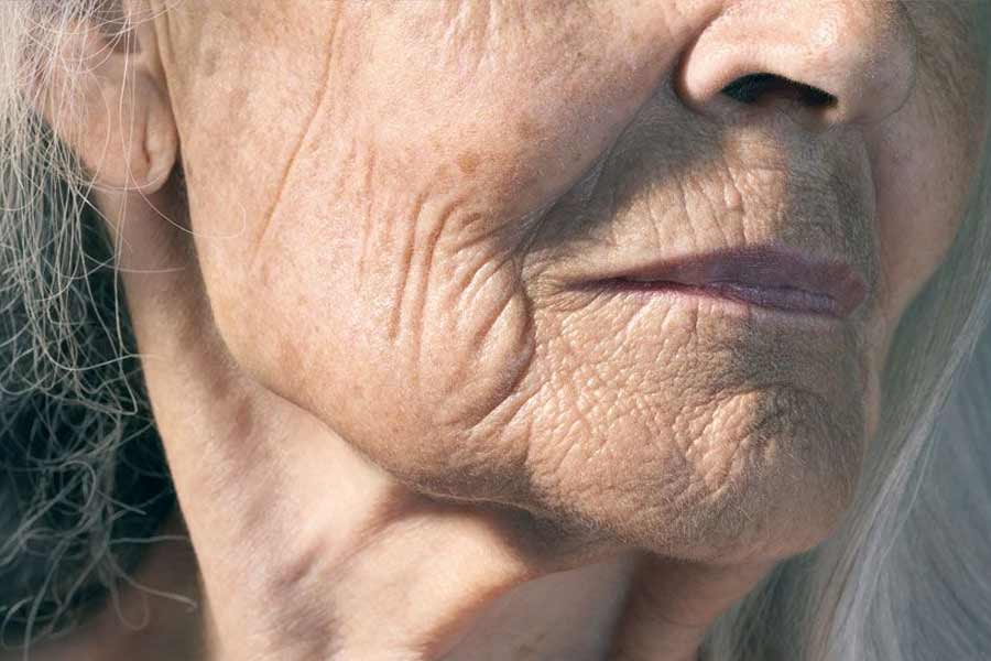 Skin-Aging