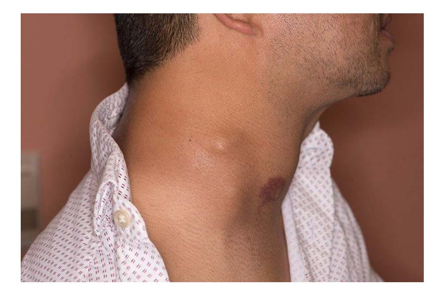 Signs of Thyroid Cancer