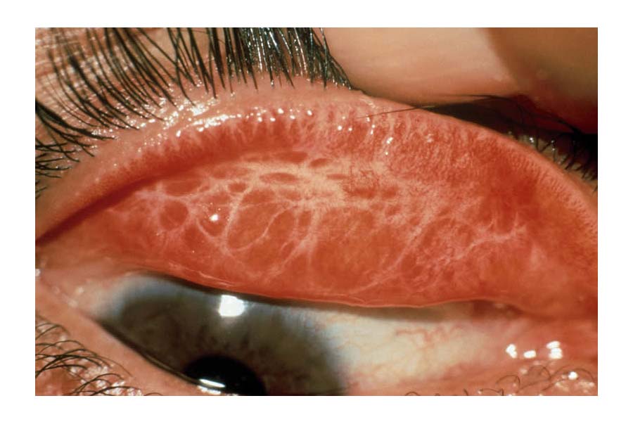 What is Trachoma, what are the symptoms and treatment for this disease