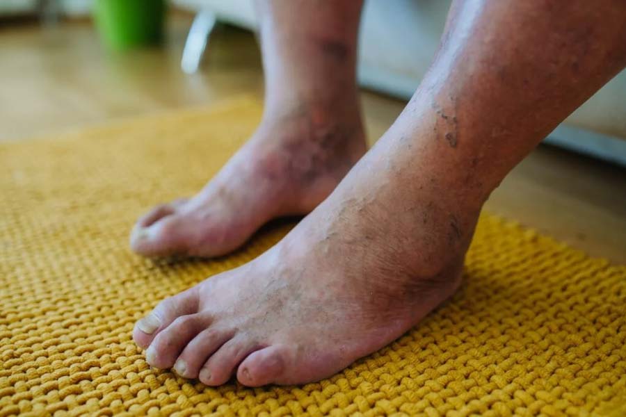 Diabetic foot care tips for winter