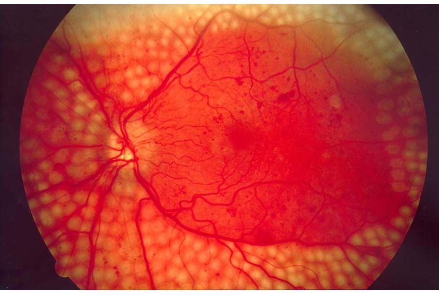 Know the Symptoms and Treatment of Diabetic Retinopathy