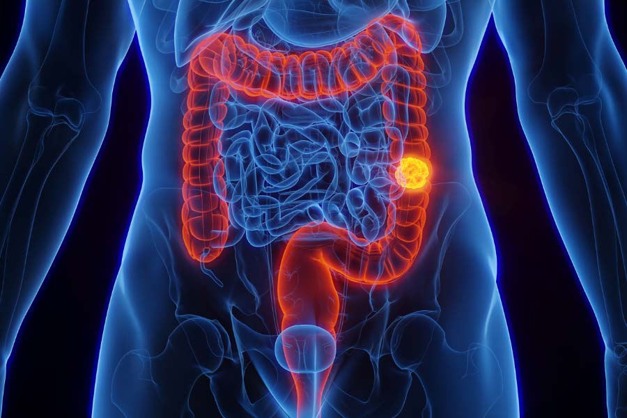 Piles vs. Colon Cancer