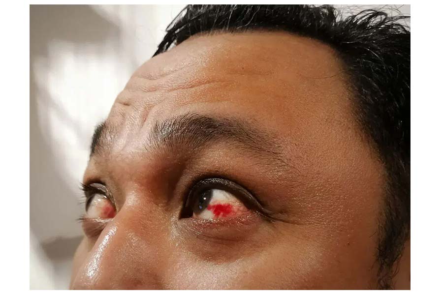 Symptoms of corneal ulcer