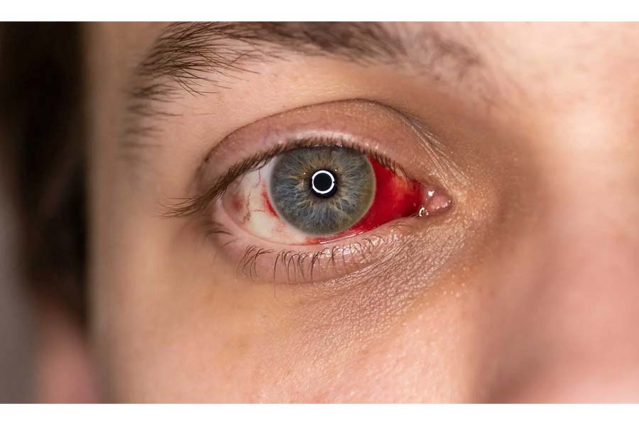 Valsalva Retinopathy led to sudden vision loss in a 27-year-old weightlifter