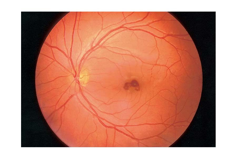 Valsalva Retinopathy led to sudden vision loss in a 27-year-old weightlifter
