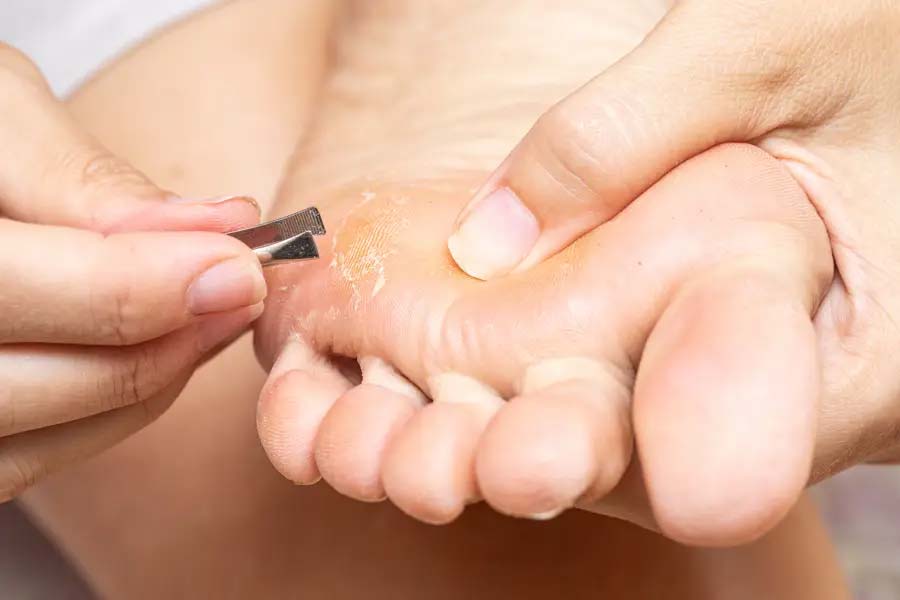 Health Tips: How to prevent hand and foot corns
