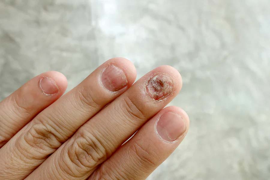 Do these things to prevent fungal infection in winter