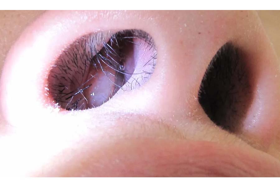 Symptoms of Nasal Polyps and Homeopathic Treatment
