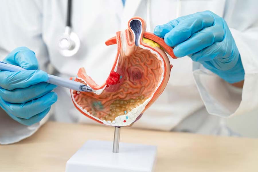 Health Tips: Smoking harms the stomach, not just lungs, US Gastroenterologist