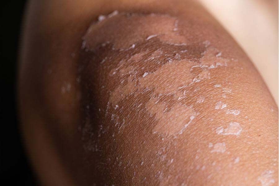 Expert tips for dry skin even after moisturizing