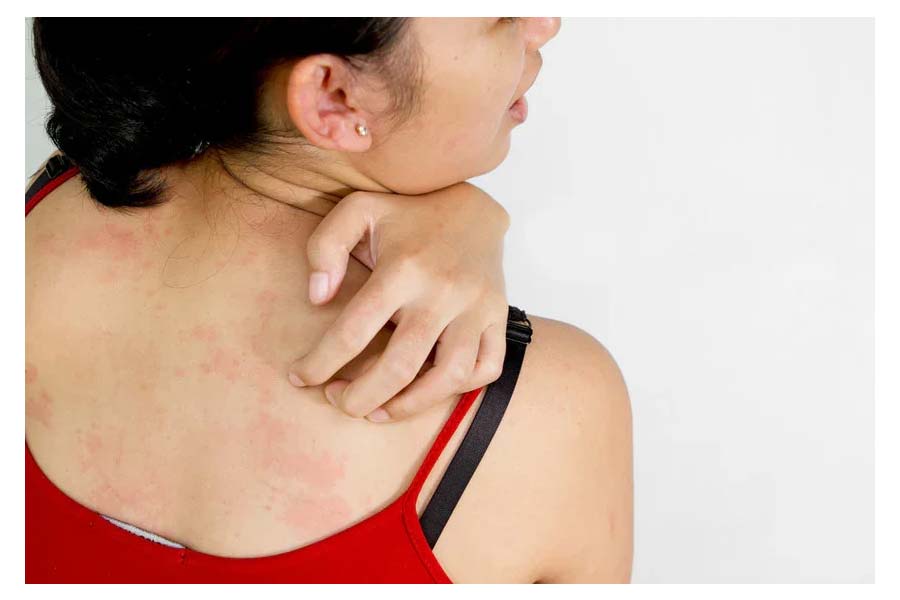 Health Tips: Why Your Sweater Causes Rashes