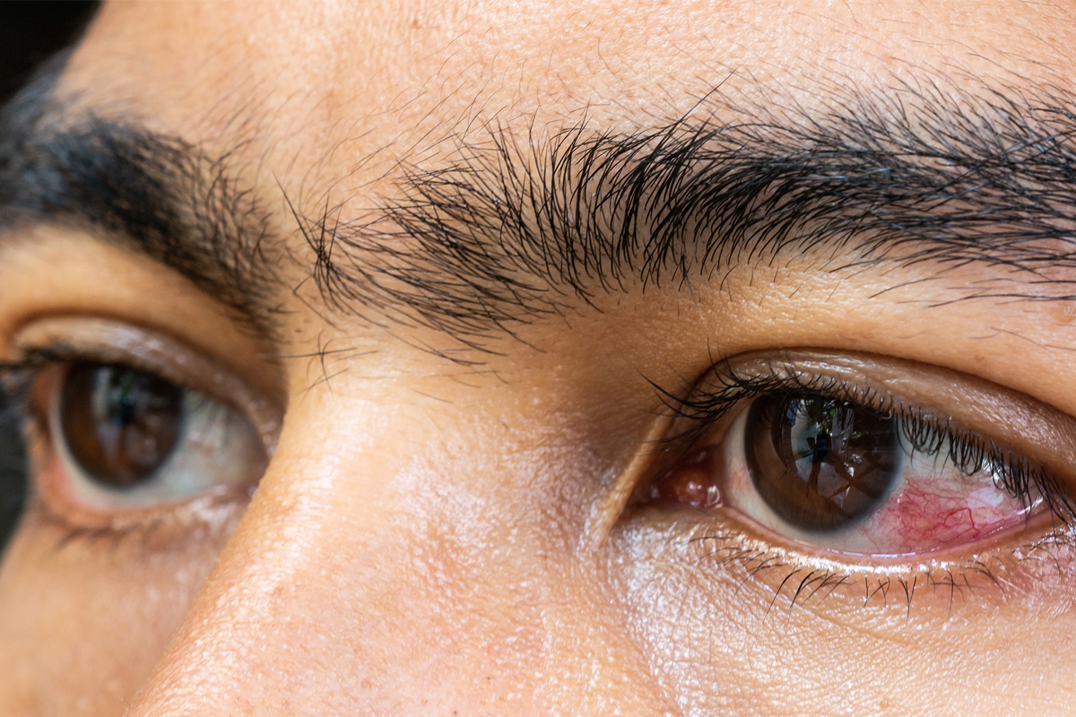 Eye red spot causes and prevention
