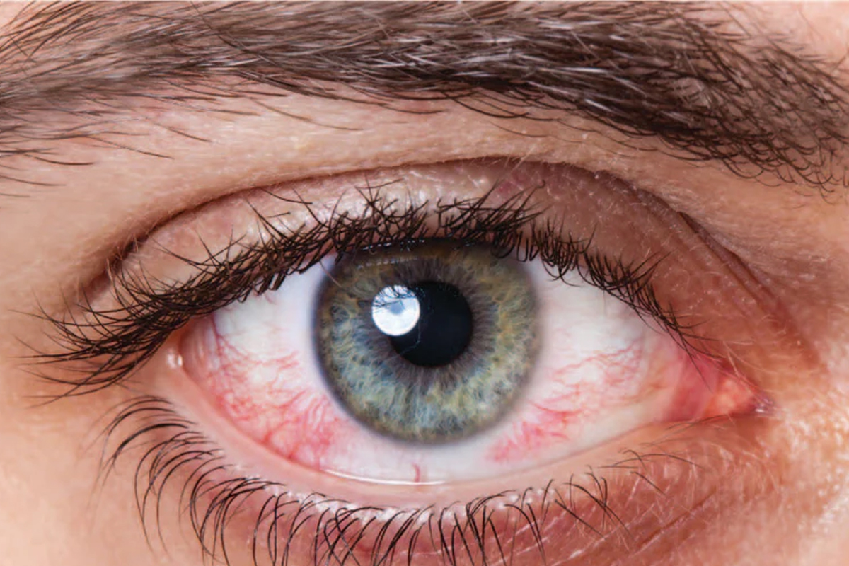 Eye red spot causes and prevention
