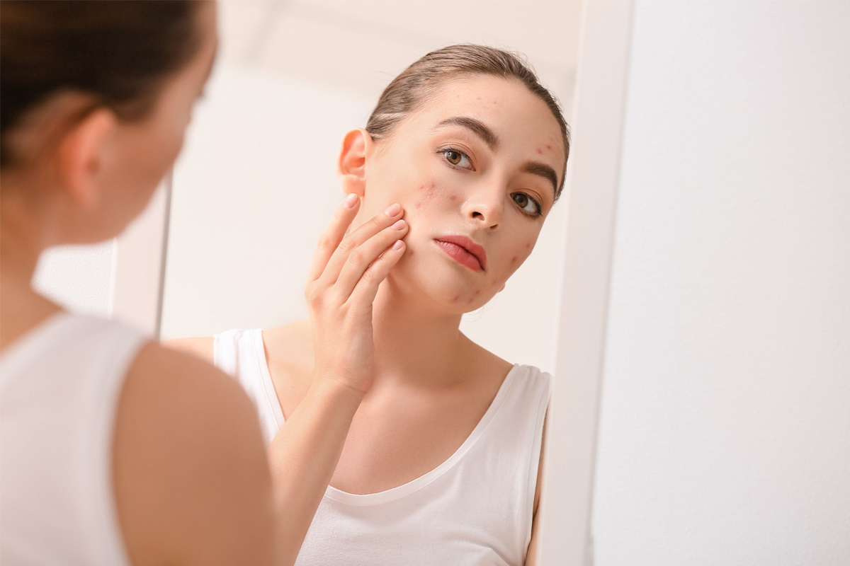 sudden acne after 30 hormonal danger signs dermatologist explains