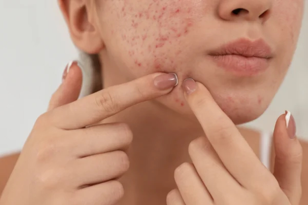 sudden acne after 30 hormonal danger signs dermatologist explains