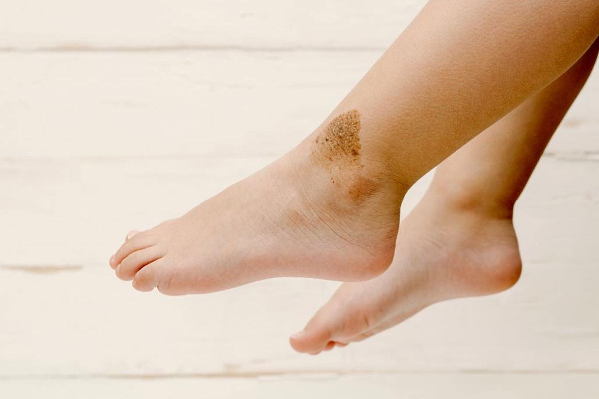 Do birthmarks reveal your past life? Discover what ancient beliefs