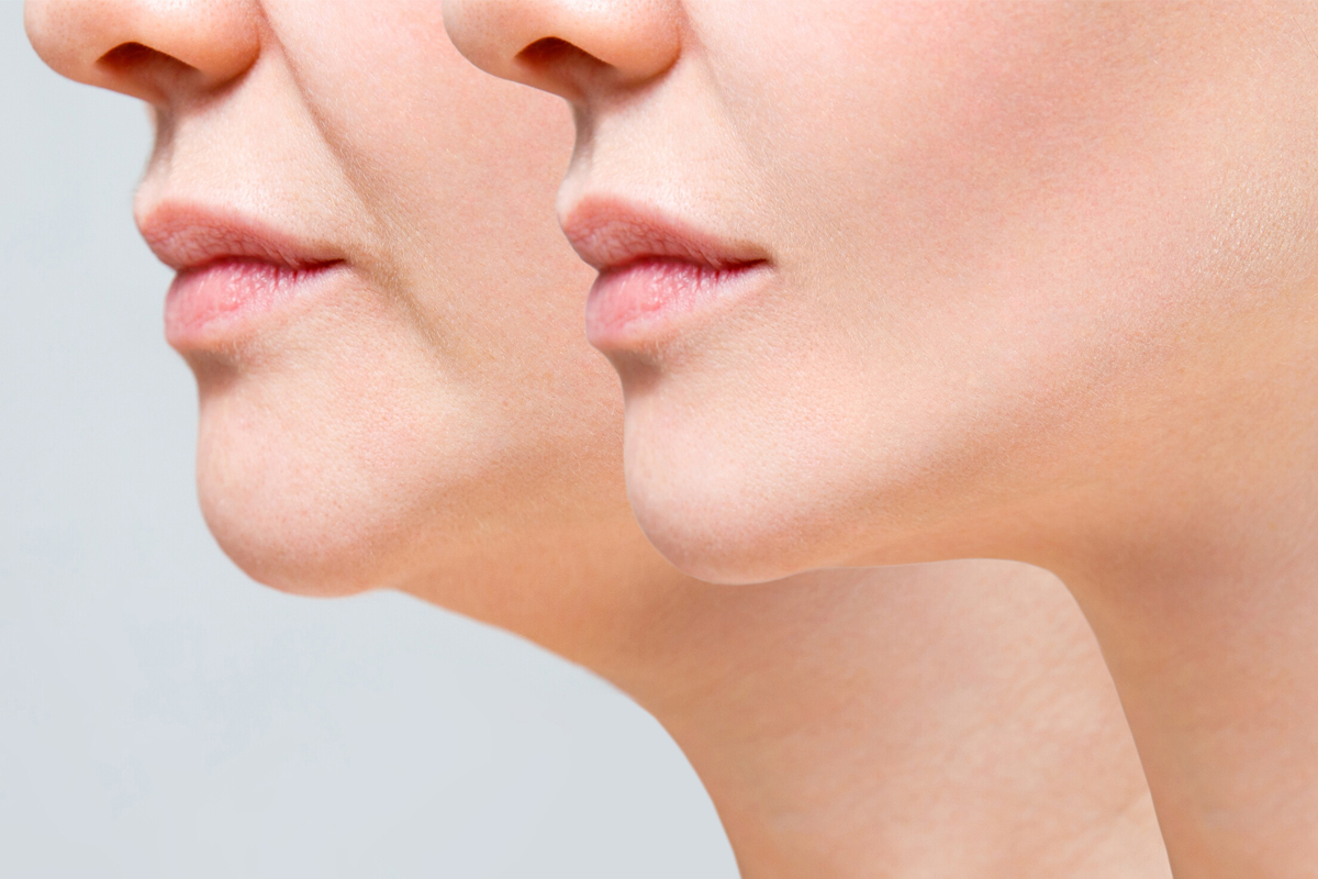 Prescription Plus: cosmetic fat transfer controversy