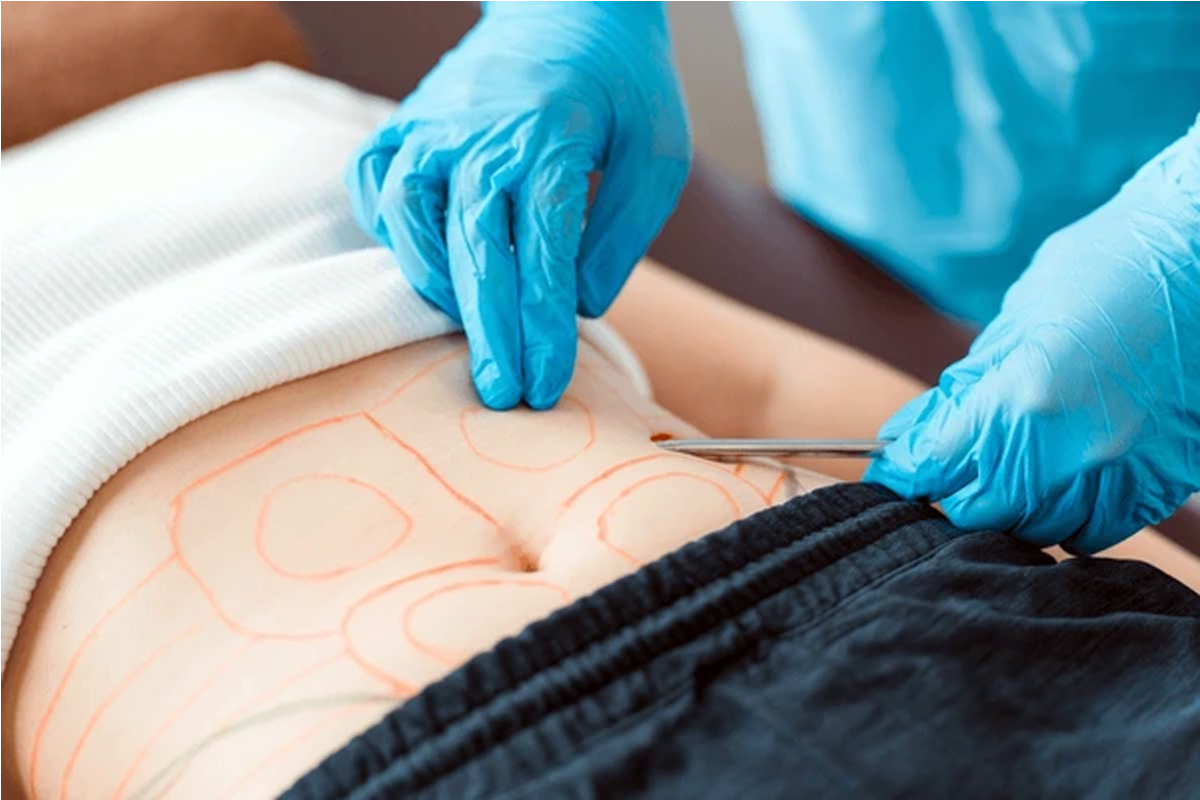 Prescription Plus: using donated human fat for body shaping