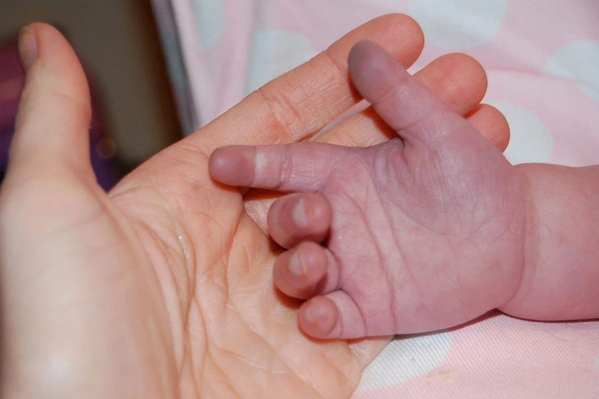 newborn blue baby syndrome warning signs early detection