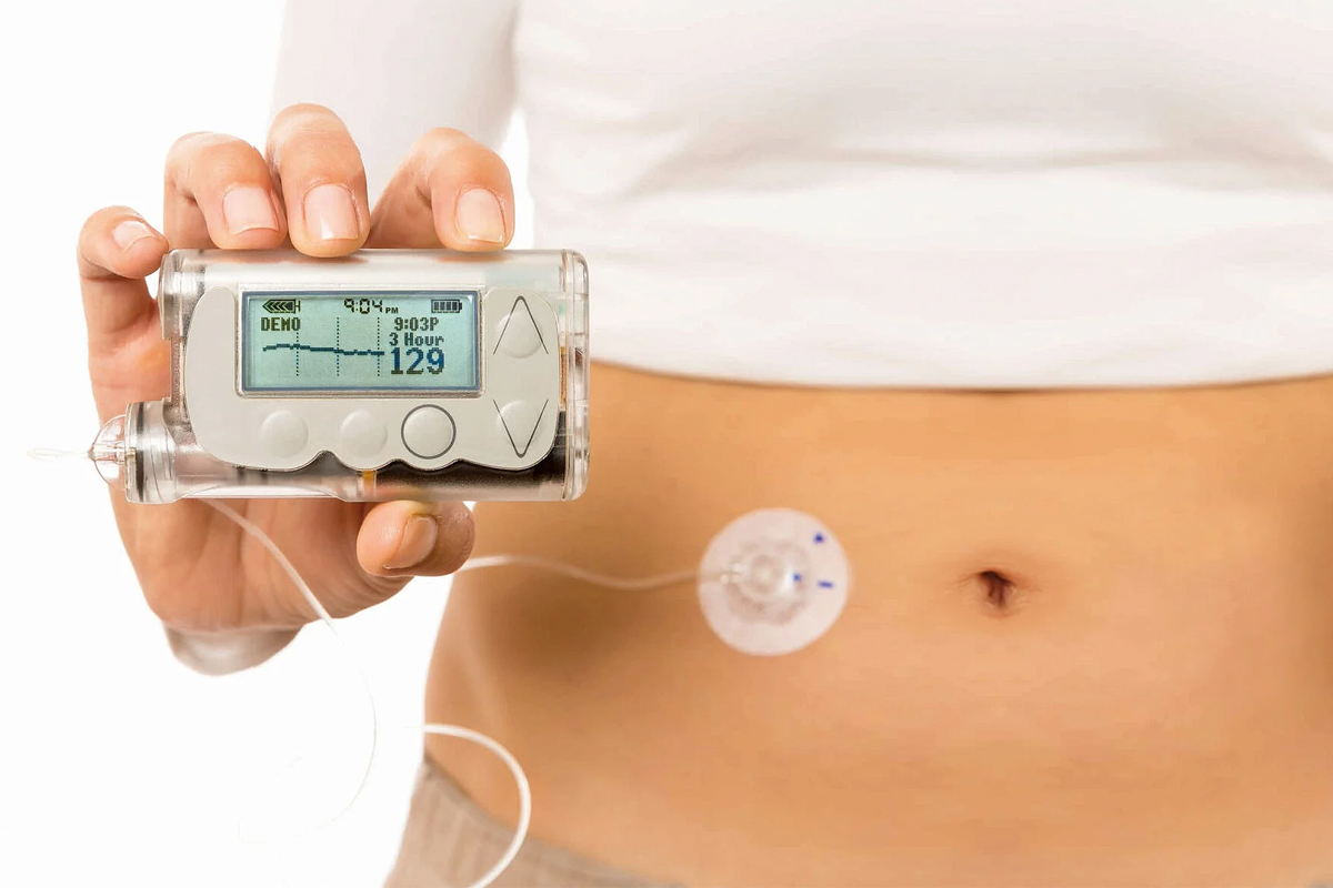 insulin pump vs injections diabetes care less stressful