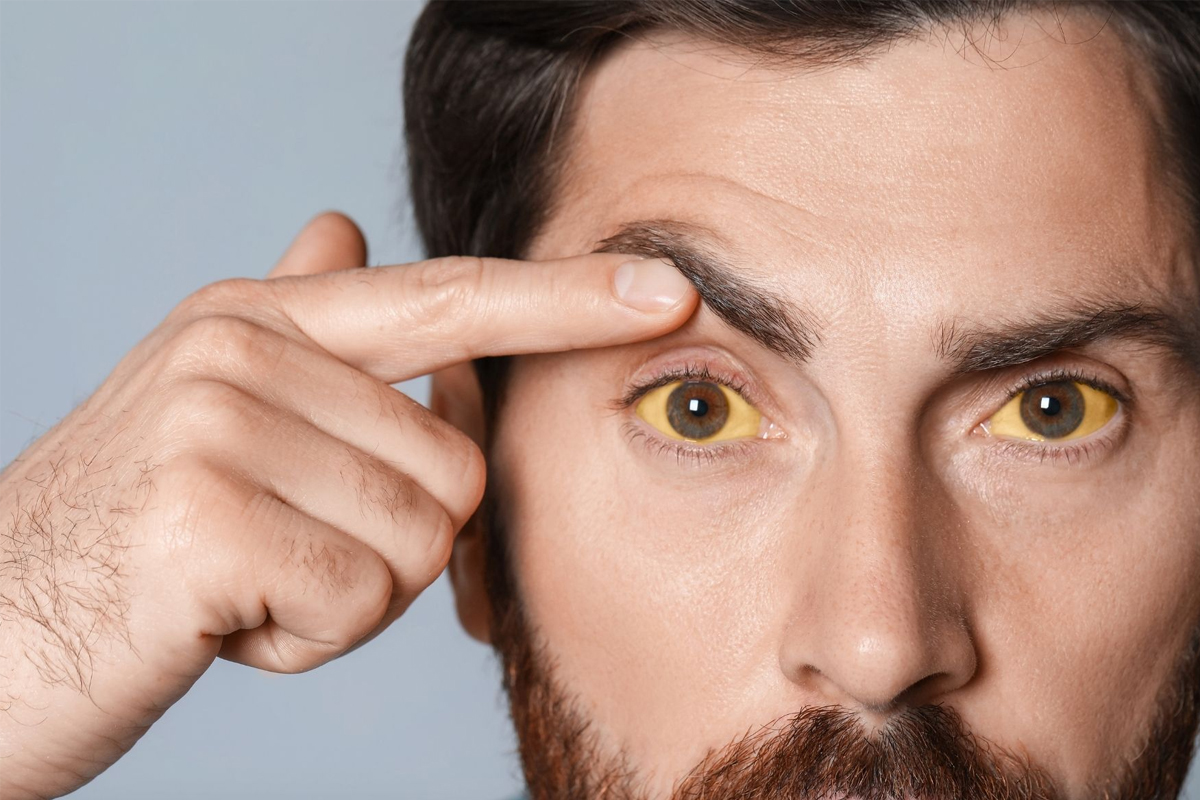  Learn the 5 eye signs that may indicate liver trouble