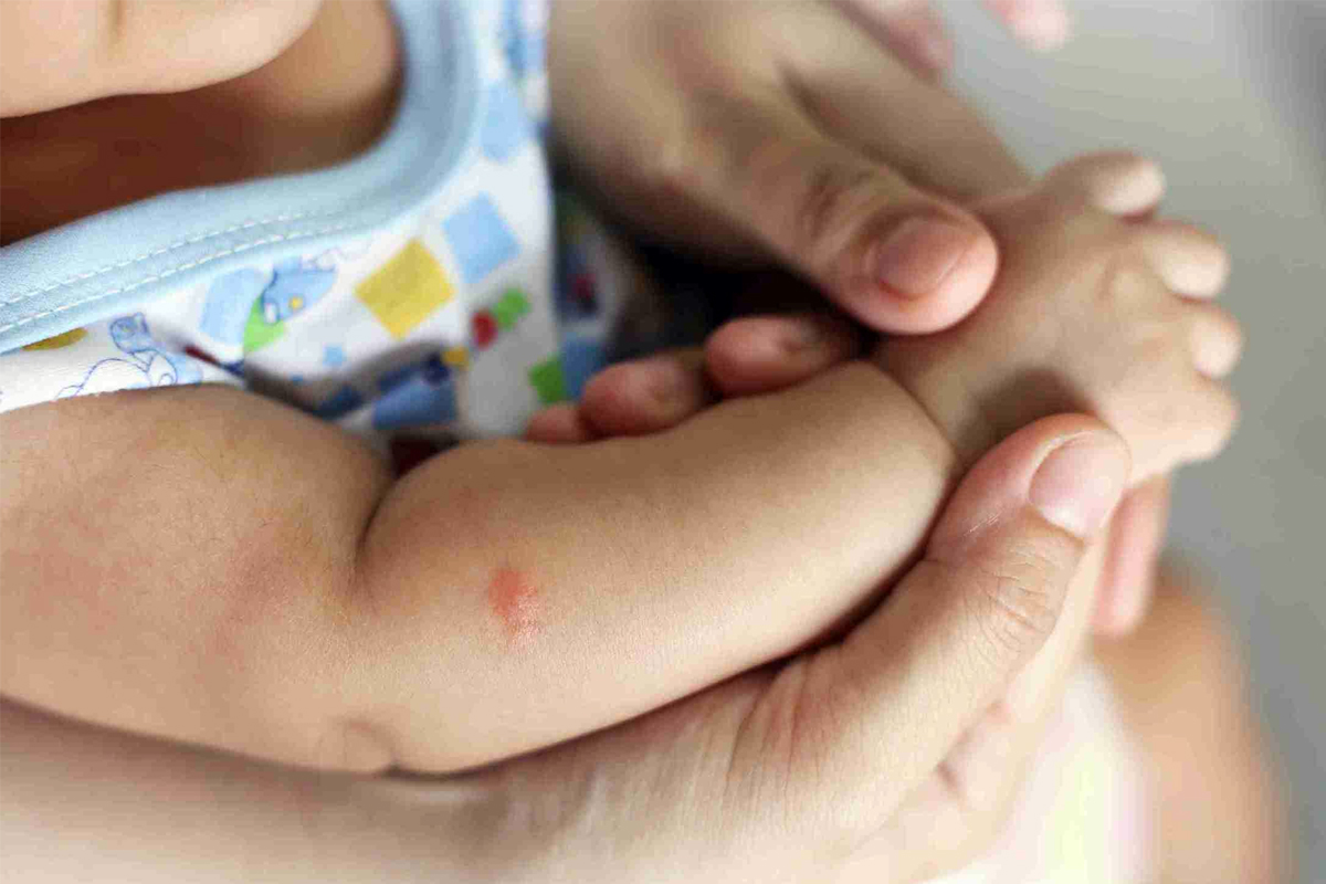 Monsoon Health Tips: What to Do After an Insect Bite and When to Seek Medical Help