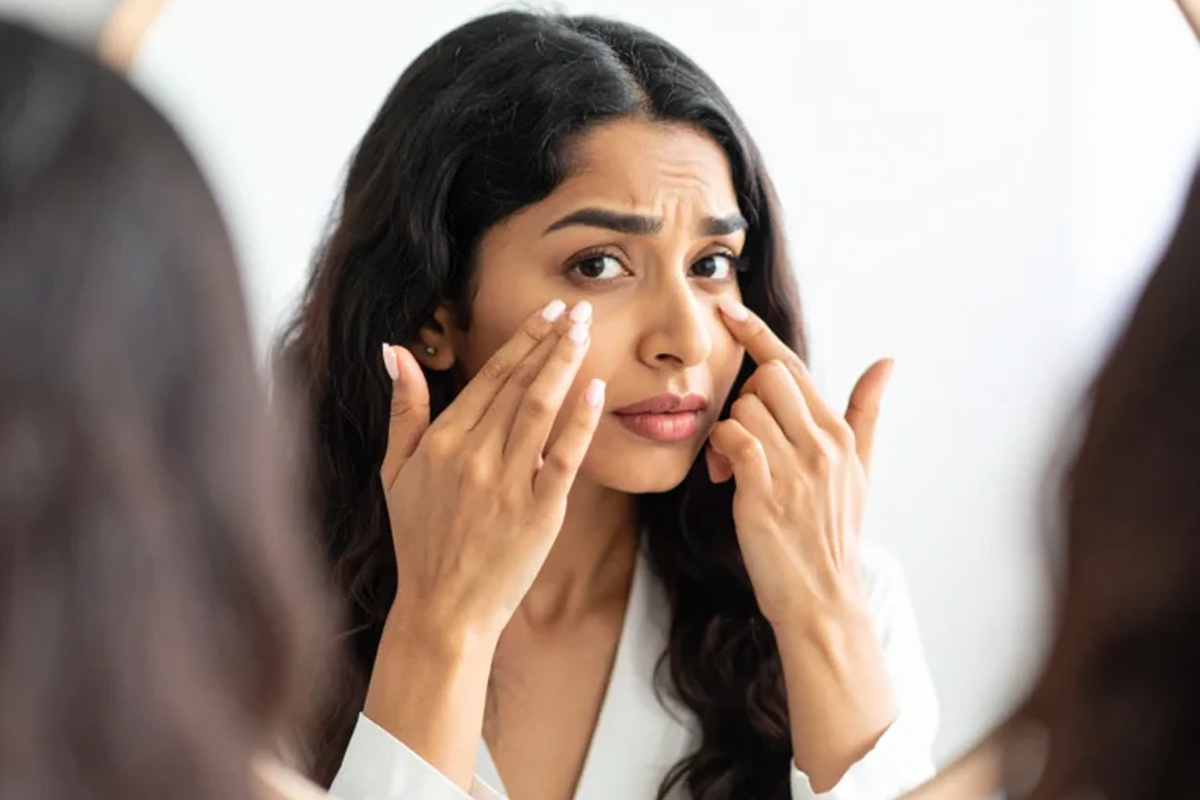 dark circles causes even after enough sleep