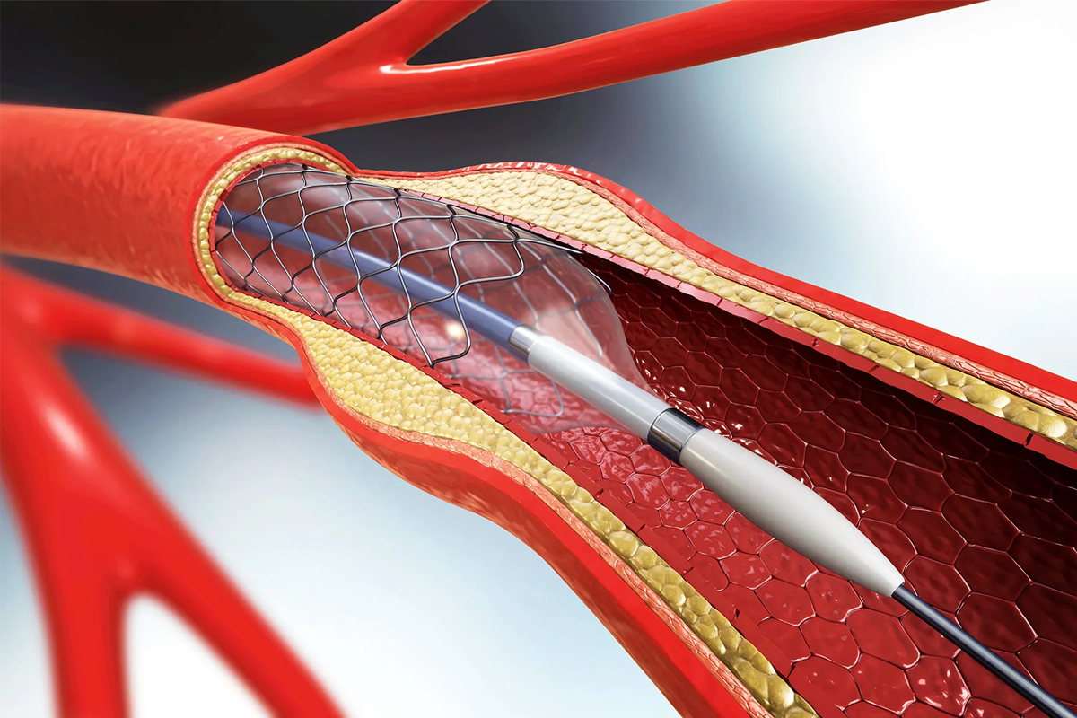 can you have heart attack after heart stent