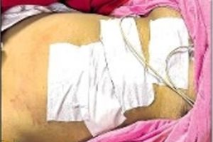 প্রৌঢ়ার বুকে আস্ত পাকস্থলী! জটিল অস্ত্রোপচার সরকারি হাসপাতালে