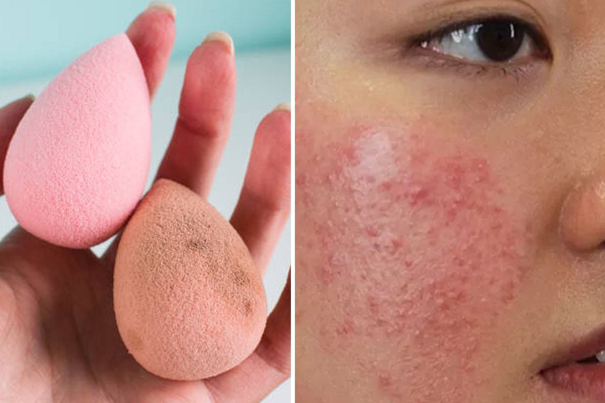 Dirty damp makeup sponge that can cause acne and skin breakouts