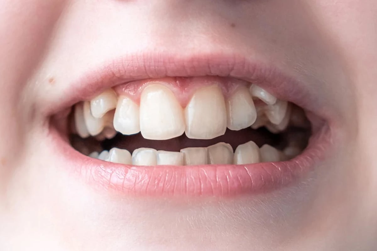 Rare case of hyperdontia: 11-year-old girl found with 81 teeth