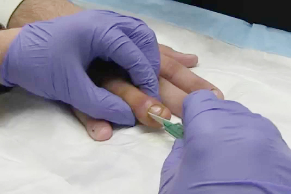 nail infection causes symptoms treatment home care