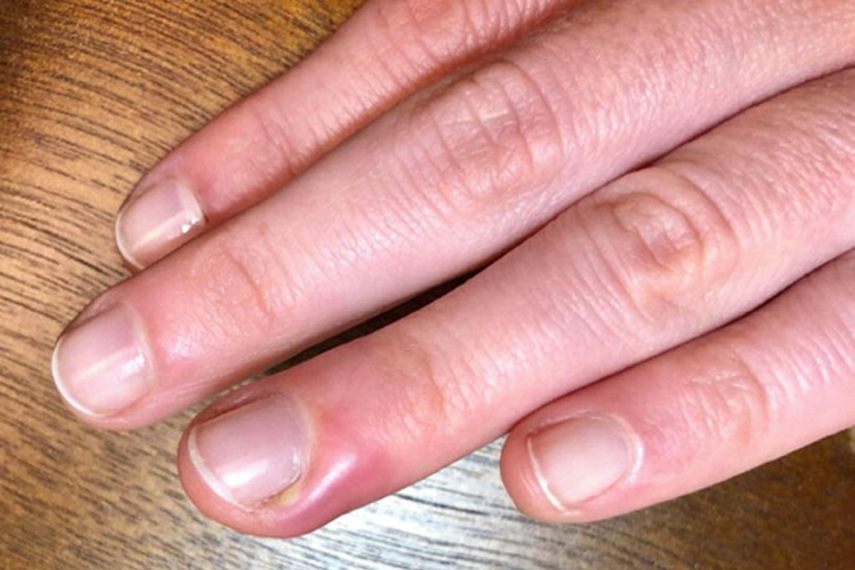 nail infection causes symptoms treatment home care