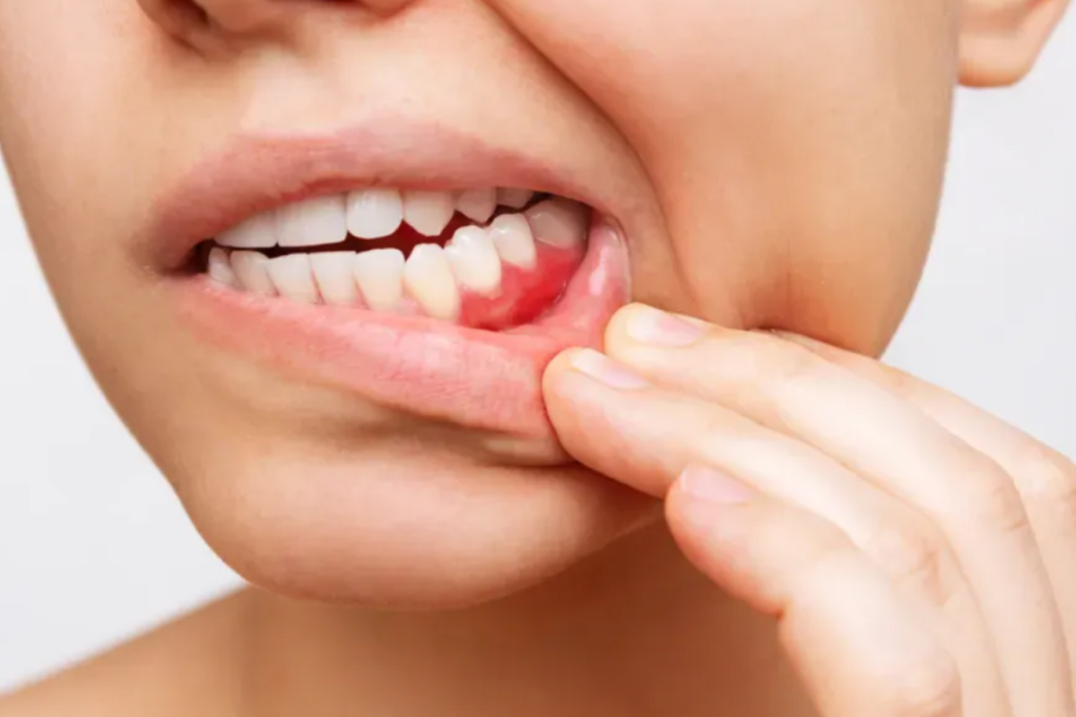 Tobacco and Areca Nut Warning: Know the Risks and Signs of Oral Cancer